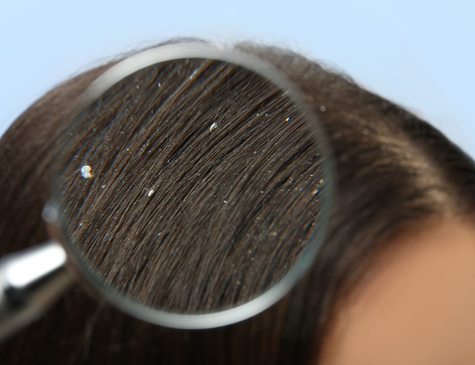 A close up image of a lady's hair with dandruff