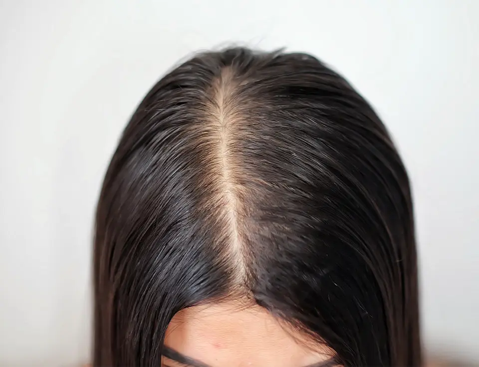 Woman with oily and thinning hairline.