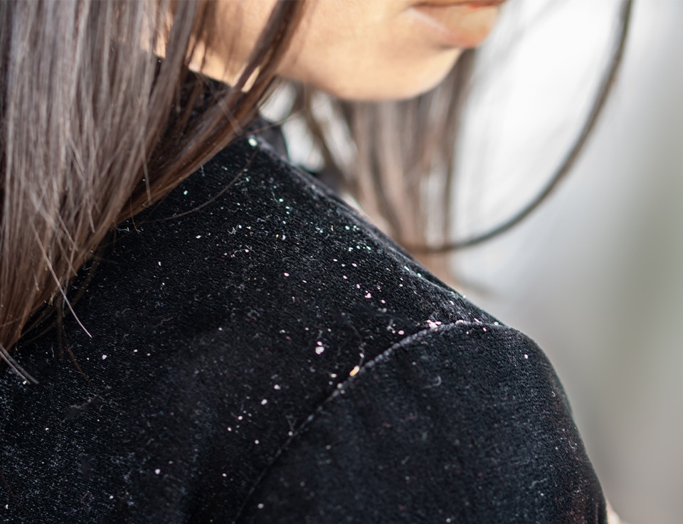 Visible hair dandruff on woman’s clothes