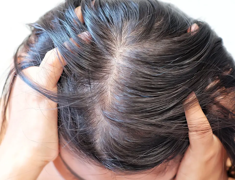 PHS HAIRSCIENCE®️ What causes oily scalp solution for oily scalp