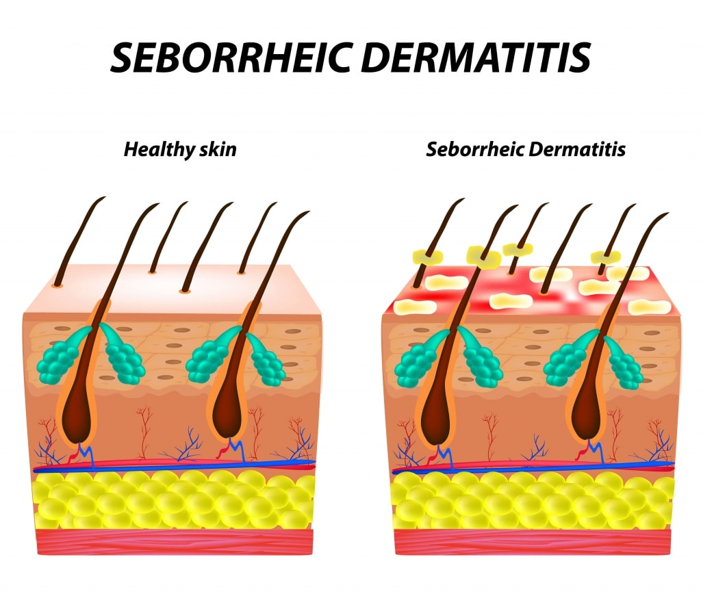 Comparison between healthy scalp and scalp with Seborrheic Dermatitis