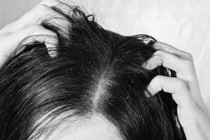 Visible dry scalp flakes