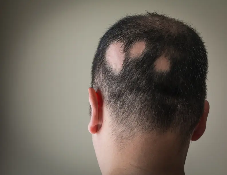 man with bald spots due to lupus