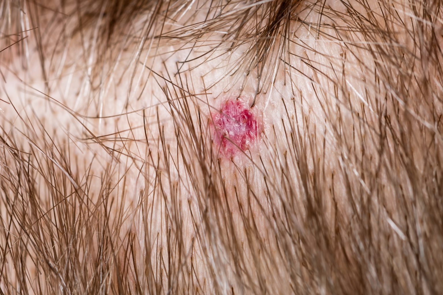 5. How to Prevent Hair Follicle Infections - wide 2