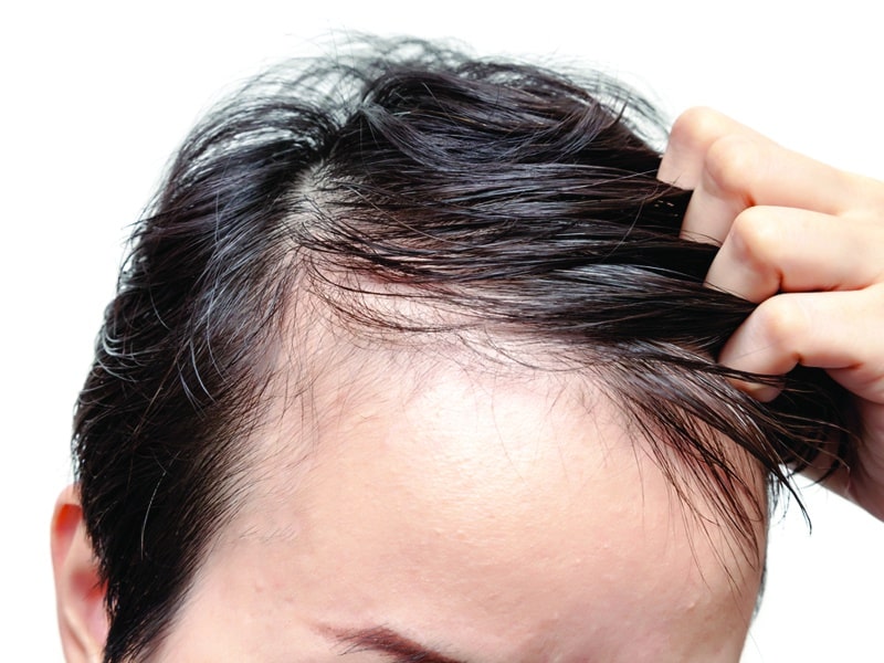 man experiencing hair loss