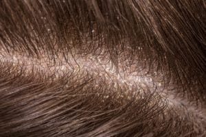Dandruff seborrhea problem of scalp and hair treatment of peeling from allergies or lichen