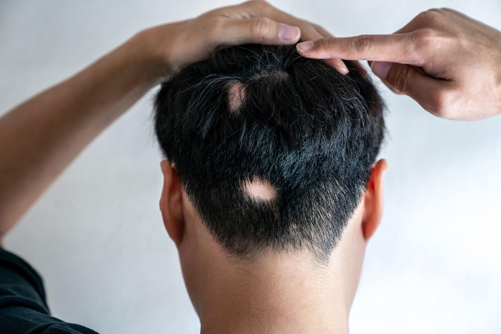 Types Of Hair Loss And How To Prevent It