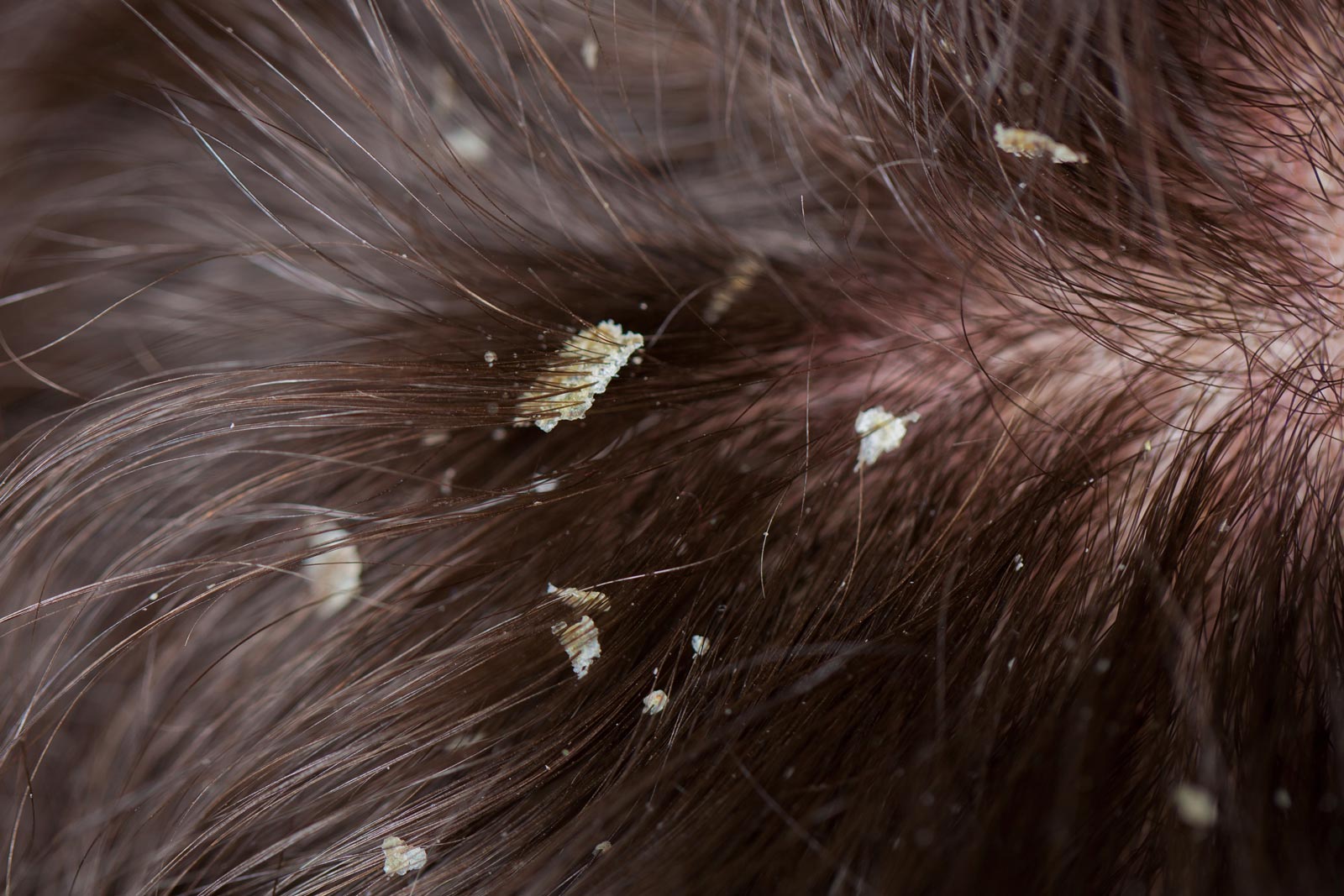 close-up of dandruff on hair and scalp