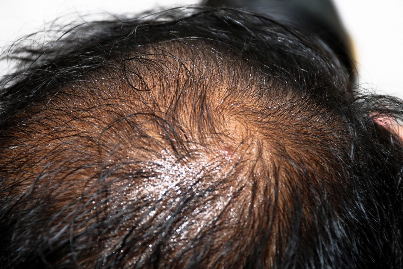 close up oily scalp