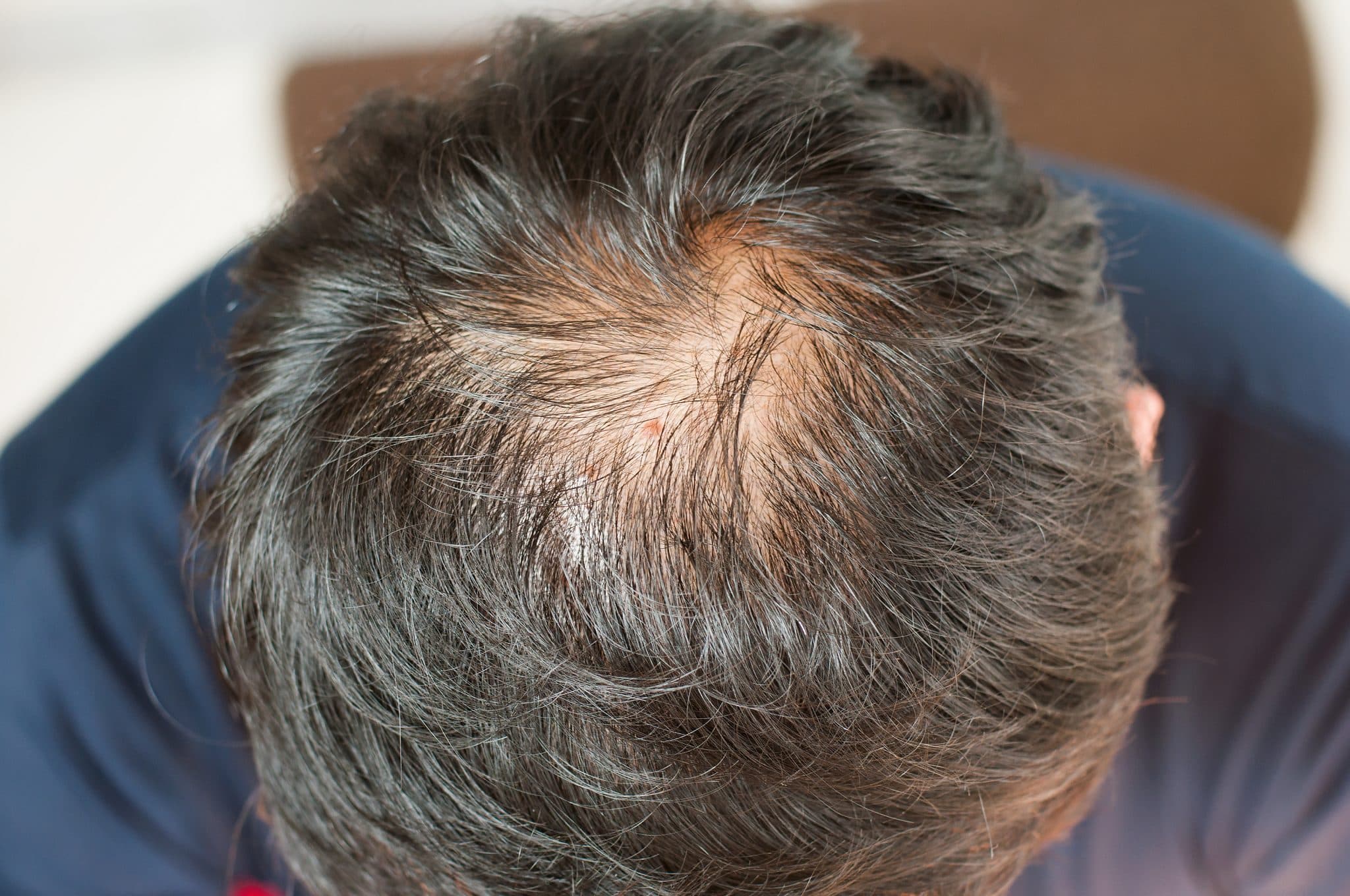 Not-to-Miss Diseases Presenting as Hair Loss: Slideshow